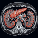 МРТ підшлункової залози