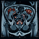 МРТ органів малого тазу